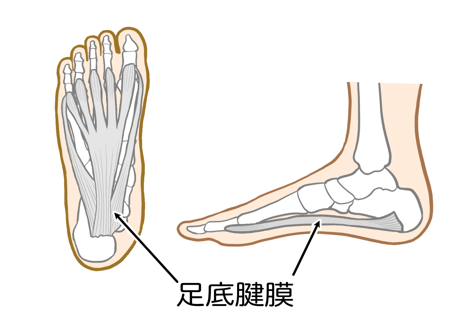 痛風とは何ですか？
